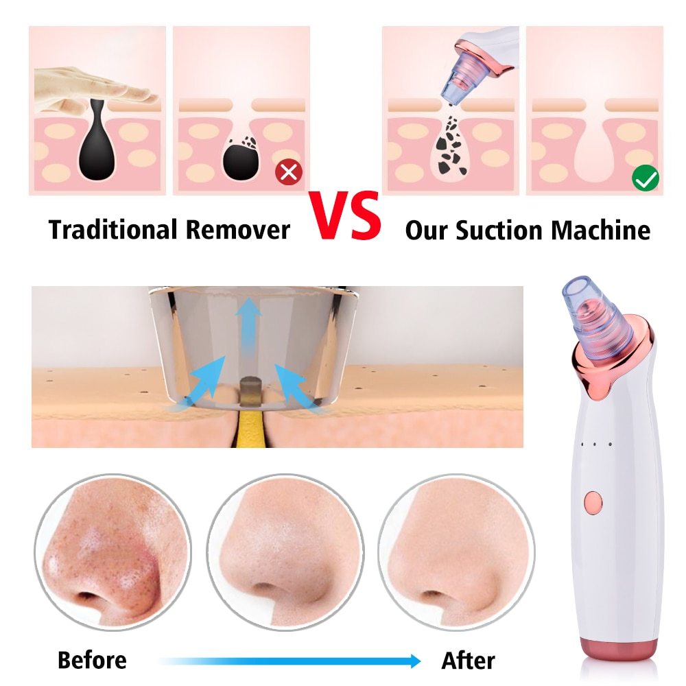 Blackhead Remover Pore Suction Acne Clearing Facial Device